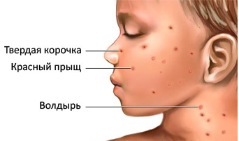 третий тип герпеса герпесная инфекция 3 типа