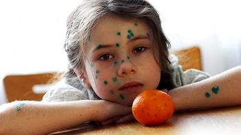 ветрянка не лечится быстро оспа у девочки