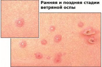 высыпание может сопровождать лихорадка