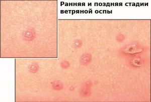 высыпания в виде красных пятен ветрянная оспа