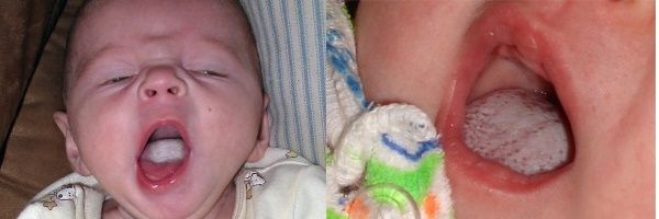 Молочница на языке у новорожденного ребенка